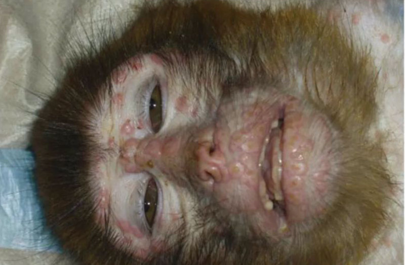 关于猴痘，我们需要了解什么？一文读懂